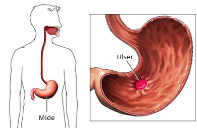 Mide ülseri>