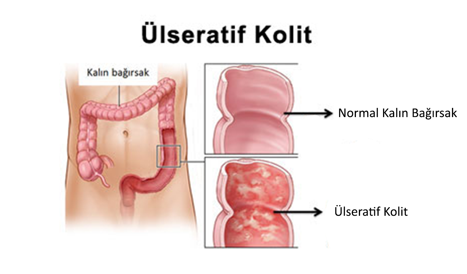Ülseratif (Kolit)>